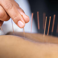 accupuncture physical therapy